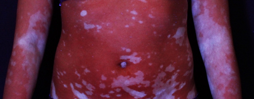 Vitiligo abdomen enfant
