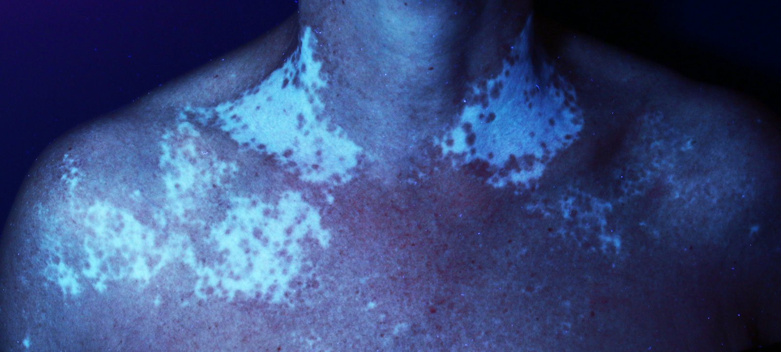 Vitiligo non segmentaire